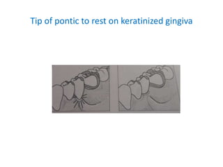 Tip of pontic to rest on keratinized gingiva
 