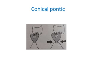 Conical pontic
 