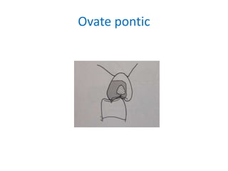 Ovate pontic
 