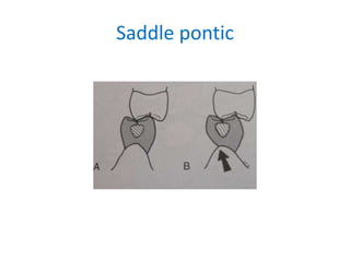 Saddle pontic
 