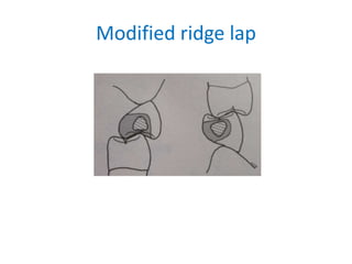 Modified ridge lap
 