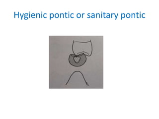 Hygienic pontic or sanitary pontic
 
