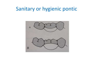 Sanitary or hygienic pontic
 