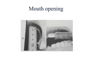 Mouth opening
 