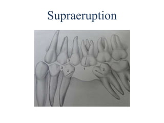 Supraeruption
 