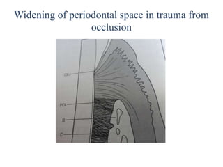 Widening of periodontal space in trauma from
occlusion
 