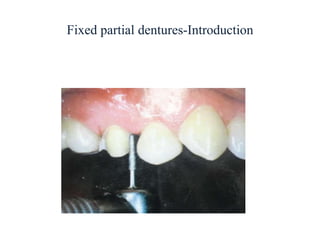 Fixed partial dentures-Introduction
 