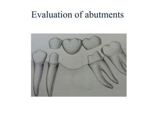 Evaluation of abutments
 