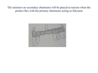 The retainers on secondary abutments will be placed in tension when the
pontics flex with the primary abutments acting as fulcrums
 