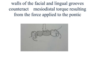 walls of the facial and lingual grooves
counteract mesiodistal torque resulting
from the force applied to the pontic
 