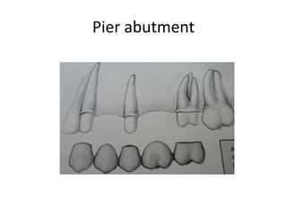 Pier abutment
 
