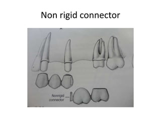 Non rigid connector
 