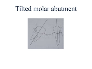 Tilted molar abutment
 