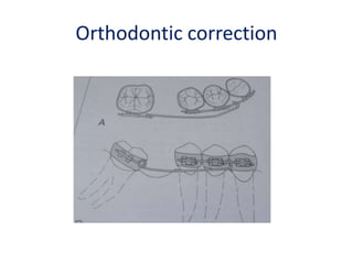Orthodontic correction
 