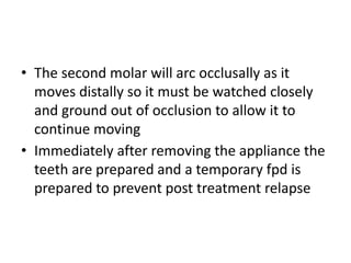 • The second molar will arc occlusally as it
moves distally so it must be watched closely
and ground out of occlusion to allow it to
continue moving
• Immediately after removing the appliance the
teeth are prepared and a temporary fpd is
prepared to prevent post treatment relapse
 