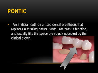 PONTIC
• An artificial tooth on a fixed dental prosthesis that
replaces a missing natural tooth , restores in function,
and usually fills the space previously occupied by the
clinical crown.
 