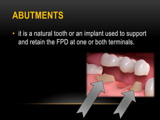 ABUTMENTS
• it is a natural tooth or an implant used to support
and retain the FPD at one or both terminals.
 