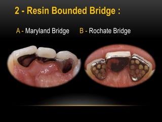 2 - Resin Bounded Bridge :
A - Maryland Bridge B - Rochate Bridge
 