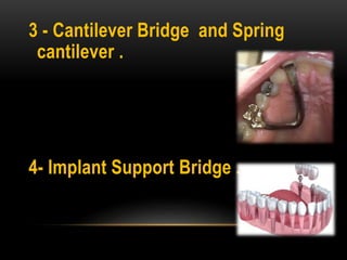 3 - Cantilever Bridge and Spring
cantilever .
4- Implant Support Bridge .
 