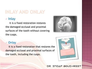    Inlay
   it is a fixed restoration restores
the damaged occlusal and proximal
surfaces of the tooth without covering
t...