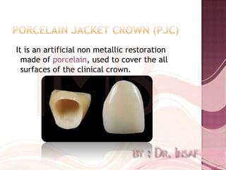 It is an artificial non metallic restoration
  made of porcelain, used to cover the all
  surfaces of the clinical crown.
 
