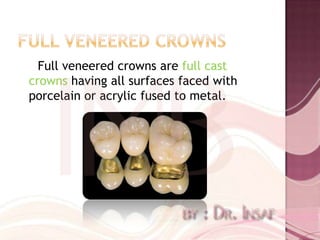 Full veneered crowns are full cast
crowns having all surfaces faced with
porcelain or acrylic fused to metal.
 
