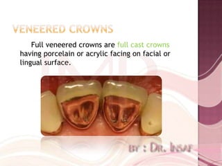Full veneered crowns are full cast crowns
having porcelain or acrylic facing on facial or
lingual surface.
 
