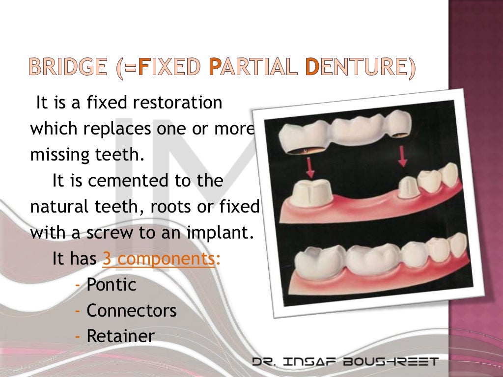 Fixed prosthodontics lesson 5