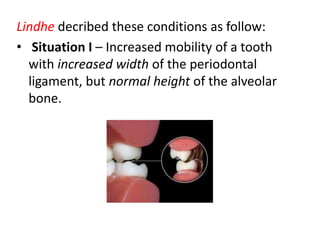 Lindhe decribed these conditions as follow:
• Situation I – Increased mobility of a tooth
with increased width of the periodontal
ligament, but normal height of the alveolar
bone.
 