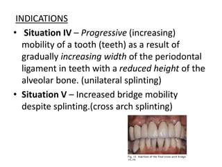 INDICATIONS
• Situation IV – Progressive (increasing)
mobility of a tooth (teeth) as a result of
gradually increasing width of the periodontal
ligament in teeth with a reduced height of the
alveolar bone. (unilateral splinting)
• Situation V – Increased bridge mobility
despite splinting.(cross arch splinting)
 