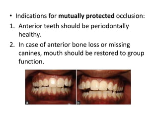 • Indications for mutually protected occlusion:
1. Anterior teeth should be periodontally
healthy.
2. In case of anterior bone loss or missing
canines, mouth should be restored to group
function.
 