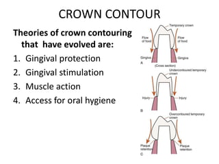 CROWN CONTOUR
Theories of crown contouring
that have evolved are:
1. Gingival protection
2. Gingival stimulation
3. Muscle action
4. Access for oral hygiene
 