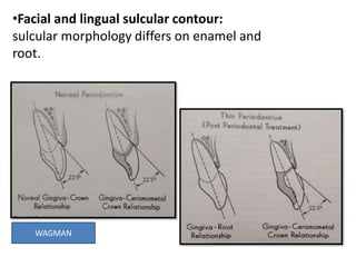 •Facial and lingual sulcular contour:
sulcular morphology differs on enamel and
root.
WAGMAN
 