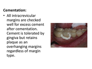 Cementation:
• All intracrevicular
margins are checked
well for excess cement
after cementation.
Cement is tolerated by
gingiva but retains
plaque as an
overhanging margins
regardless of margin
type.
 