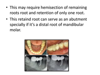 • This may require hemisection of remaining
roots root and retention of only one root.
• This retaind root can serve as an abutment
specially if it’s a distal root of mandibular
molar.
 
