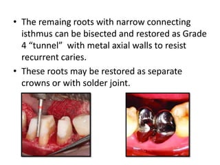 • The remaing roots with narrow connecting
isthmus can be bisected and restored as Grade
4 “tunnel” with metal axial walls to resist
recurrent caries.
• These roots may be restored as separate
crowns or with solder joint.
 
