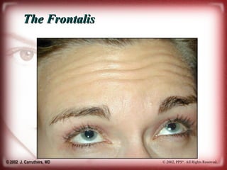 Frontalis Patterns Facial Aging Process and Anatomy | PPT