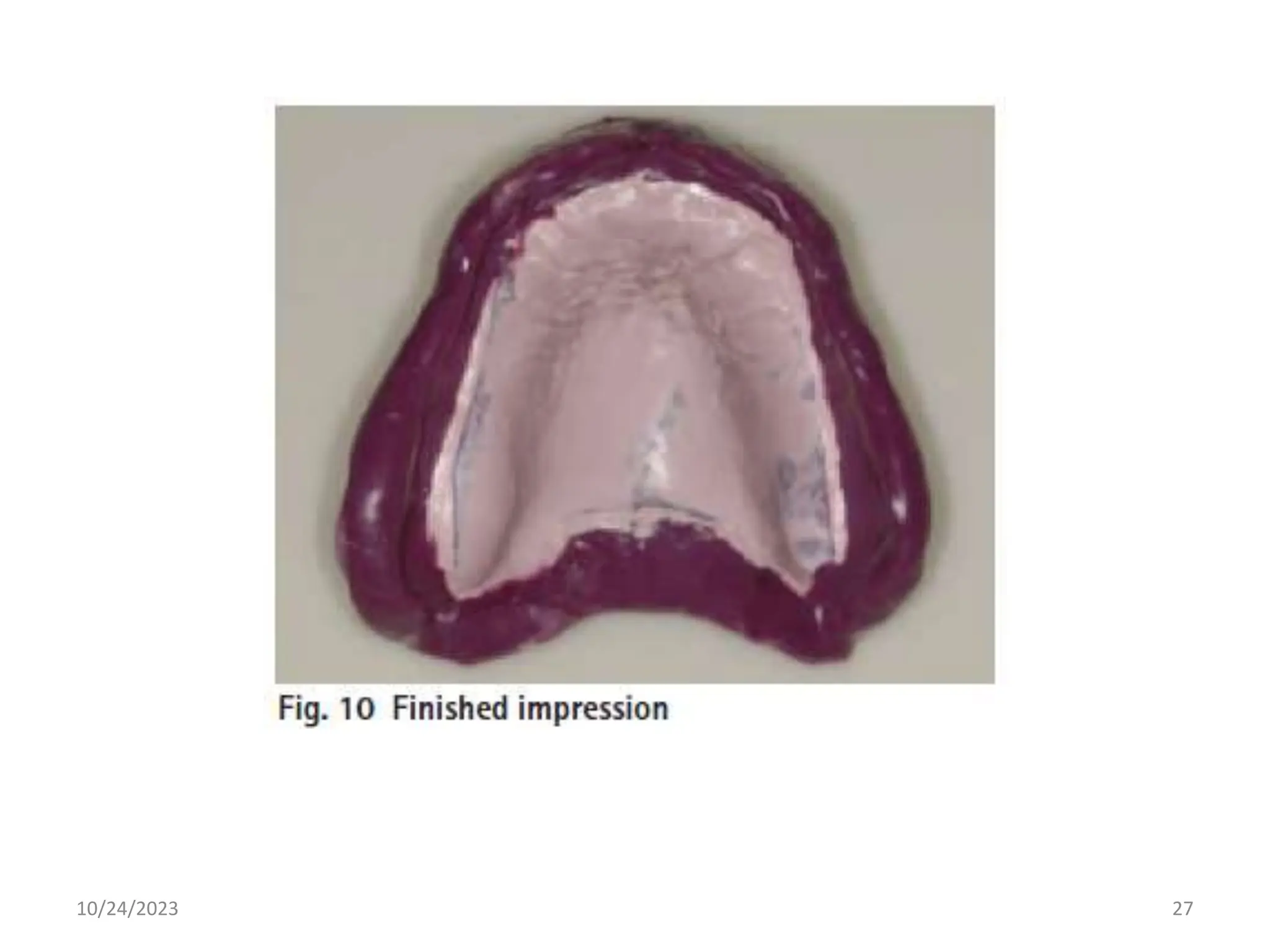 Journal club on Management of flabby ridges | PPTX