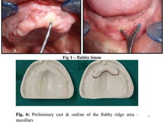Flabby Ridge Radiograph Journal club on Management of flabby ridges | PPTX