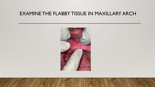 Flabby Ridge Radiograph Complete Denture Fabrication for Flabby Ridge Using Window Technique | PPTX