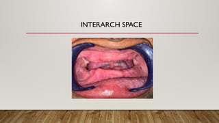 Complete Denture Fabrication for Flabby Ridge Using Window Technique | PPTX