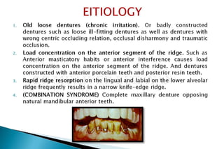 Flabby ridge manage | PPTX
