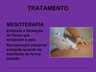 TRATAMENTO
MESOTERAPIA
 Estimula a formação
de fibras que
enrijecem a pele.
 Recuperação plausível
somente quando se
manifesta de forma
isolada;
 