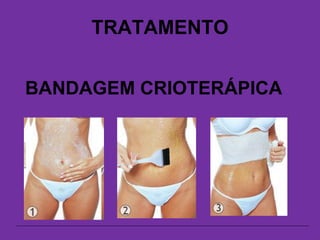 TRATAMENTO
BANDAGEM CRIOTERÁPICA
 