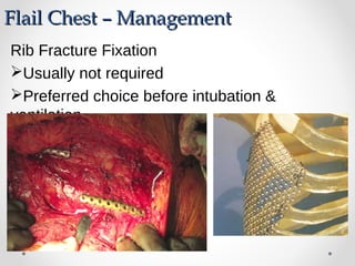 Flail Chest – ManagementFlail Chest – Management
Rib Fracture Fixation
Usually not required
Preferred choice before intubation &
ventilation.
 