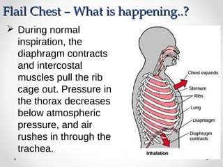  During normal
inspiration, the
diaphragm contracts
and intercostal
muscles pull the rib
cage out. Pressure in
the thorax decreases
below atmospheric
pressure, and air
rushes in through the
trachea.
Flail Chest – What is happening..?Flail Chest – What is happening..?
 