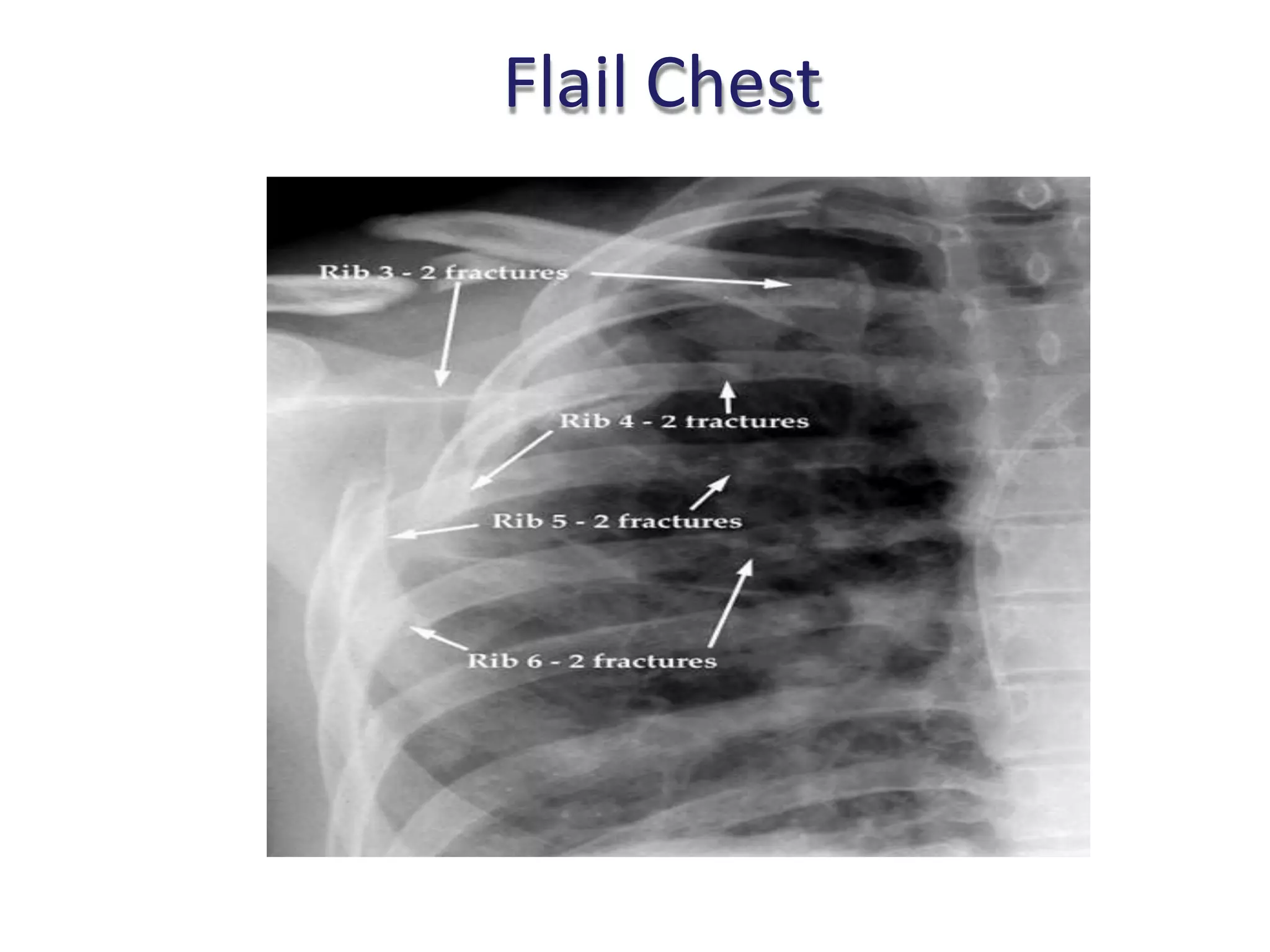 Flail chest PPT