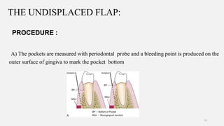 periodontal flap | PPTX