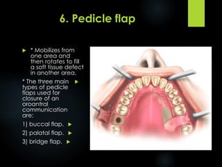 Pedicle Flaps Example Flap Design for Minor Oral Surgery | PDF