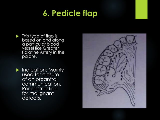 Flap Design for Minor Oral Surgery | PDF | Dental Health | Diseases and ...